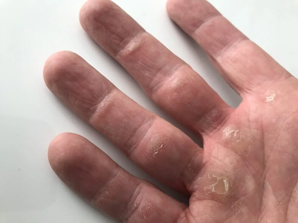 Callouses on hands