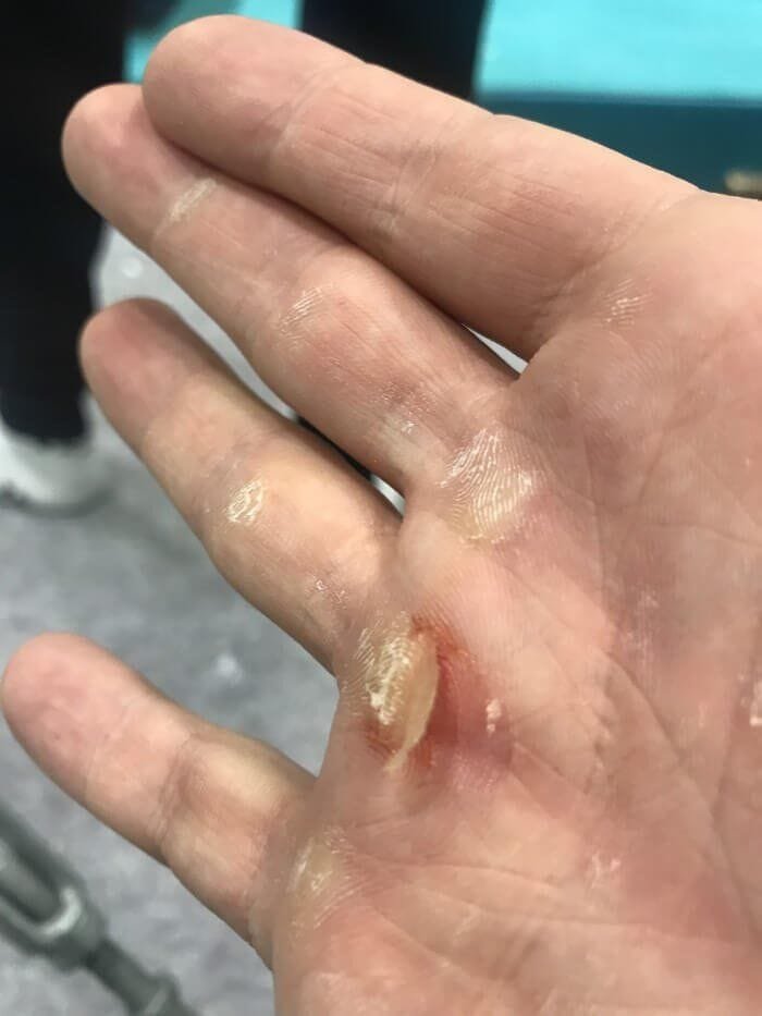 Ripped callouses on the hands